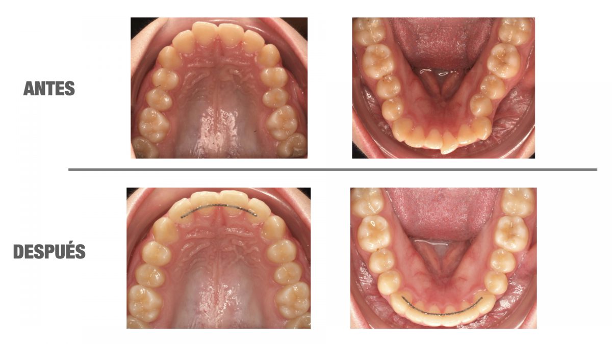 Como Saber Si Mi Ortodoncia Quedó Bien